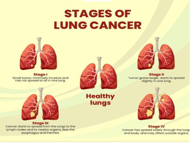 Learn More About Lung Cancer Its Symptoms Risk Factors Prevention