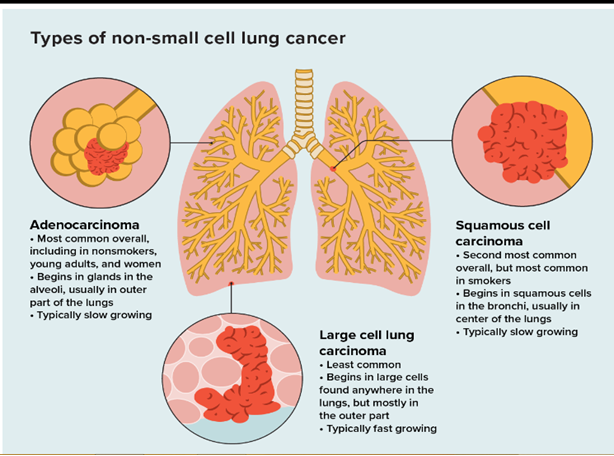 Lung Cancer