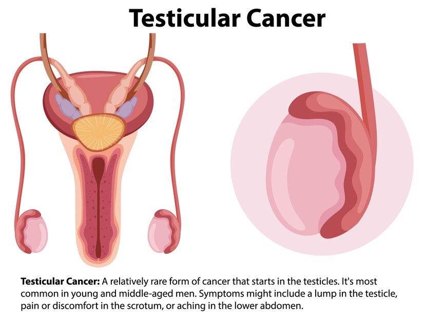 testicular Cancer