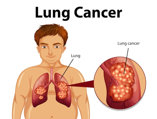 lung cancer