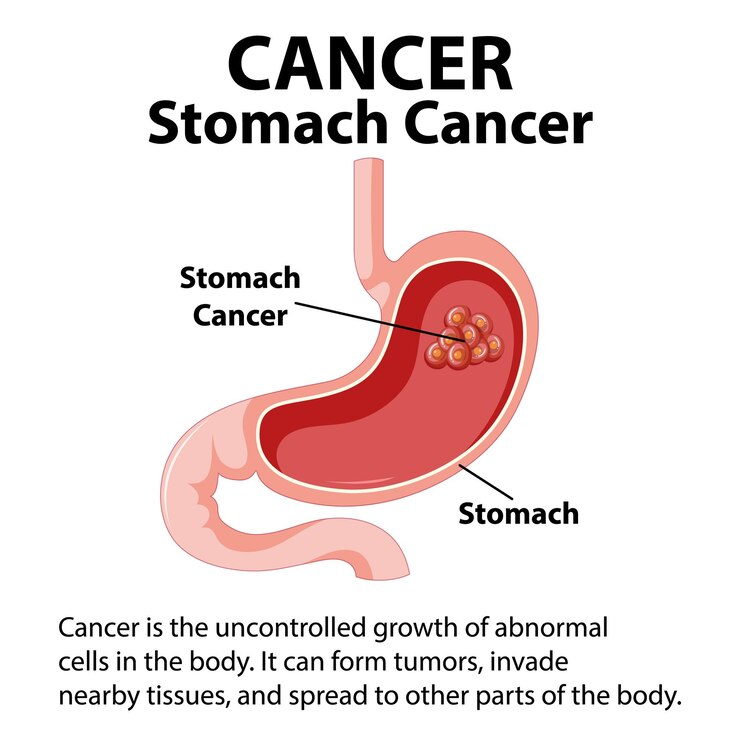 stomach cancer